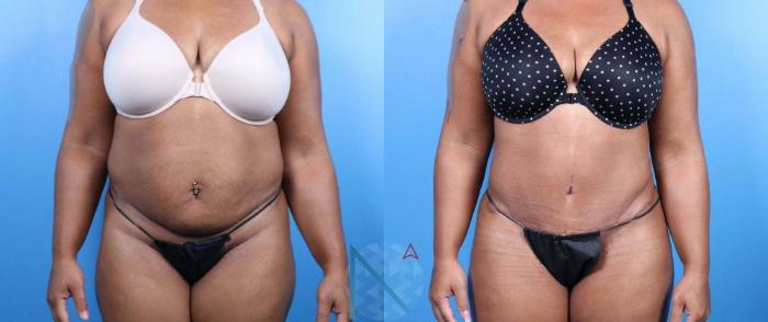 Before & After Tummy Tuck Case 127 View 1 View in Raleigh, NC