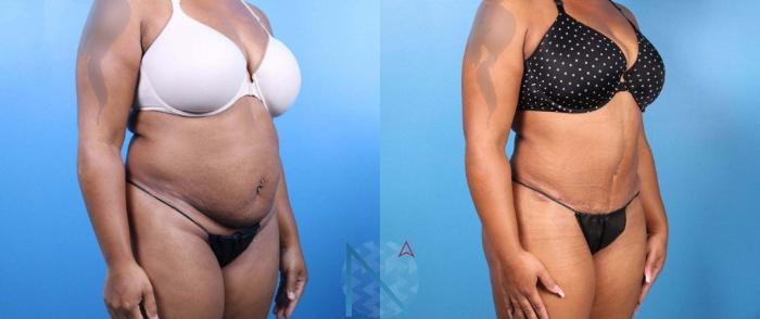 Before & After Tummy Tuck Case 127 View 2 View in Raleigh, NC