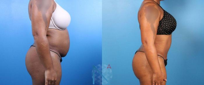 Before & After Tummy Tuck Case 127 View 3 View in Raleigh, NC