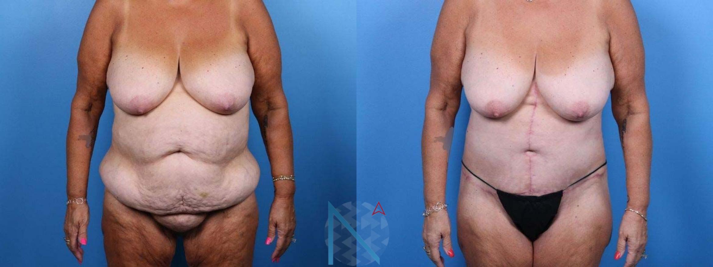 Before & After Tummy Tuck Case 128 View 1 View in Raleigh, NC