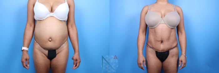 Before & After Tummy Tuck Case 129 View 1 View in Raleigh, NC